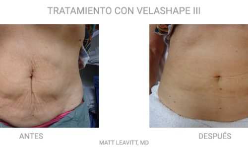 TRATAMIENTO_VELASHAPE_1