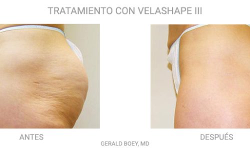 TRATAMIENTO_VELASHAPE_2